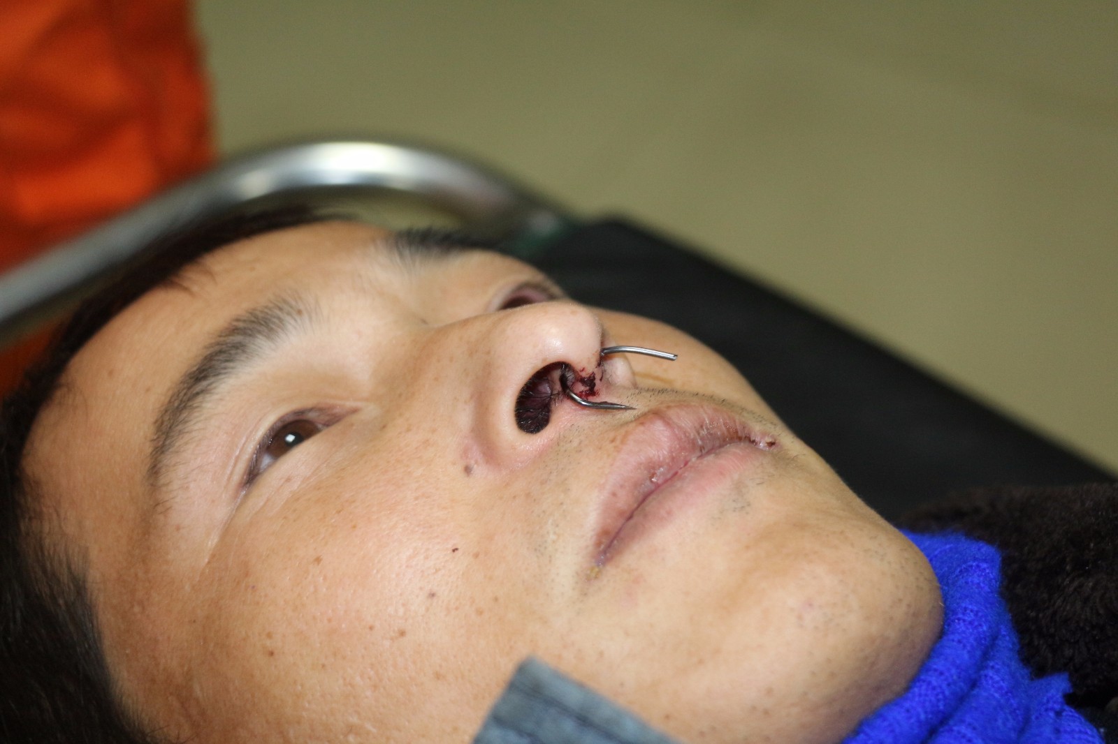 河南安阳 捕鱼不慎鼻子被钩 消防战士成功 手术