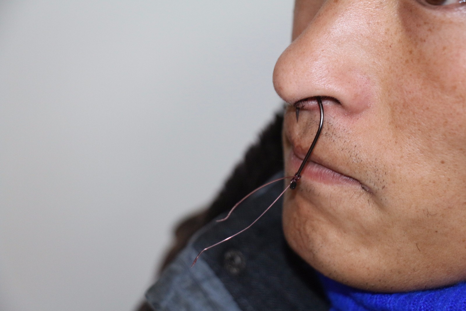 河南安阳 捕鱼不慎鼻子被钩 消防战士成功 手术