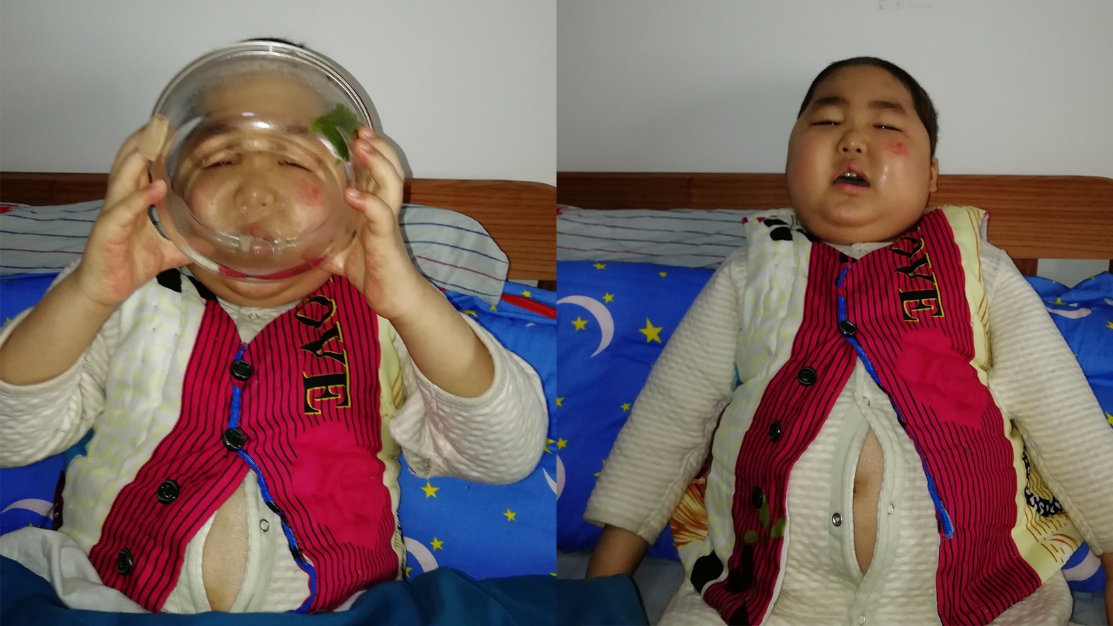 四岁重症儿患罕见血液病,一天吃八顿撑鼓肚子仍喊饿