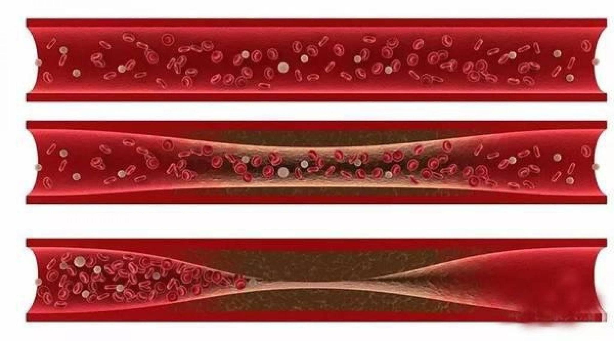 动脉粥样硬化可以逆转,一招可将血管壁清理干净,软化血管溶血栓