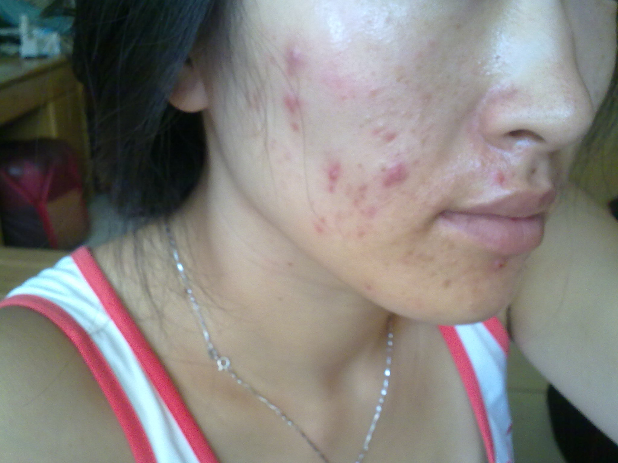 如果你只是有时候长痘痘的话,可以直接用面前蘸取一点蜂蜜,均匀的涂抹