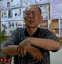 脑梗后遗症为何难恢复!专家:脑细胞缺氧3分钟不可再生