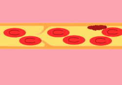 女孩崴脚12天后死亡,这个潜在危险你一定想不到|肺栓塞|静脉血栓|久坐