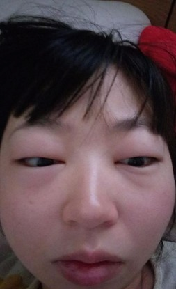 台湾大眼萌妹一觉睡醒脸肿成猪头,原来是五星级剩菜害的!