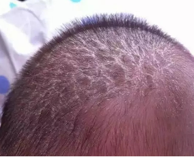 宝宝头上有头垢?千万不要用手去扣,简单方法教你解决