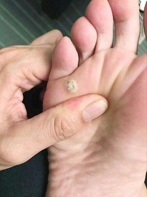 专家教你5秒分辨,治愈扁平疣,寻常疣,跖疣,尖锐湿疣不复发!
