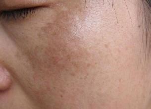 怀孕后脸上长黑斑很正常, 做好这几点让你貌美如初!