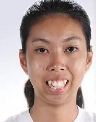 泰国龅牙妹整容后从"怪物"变校园女神,朋友:感觉像换了个头!