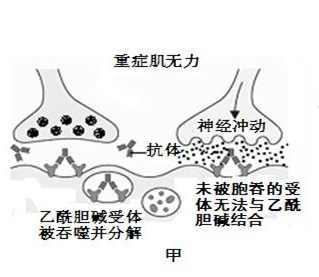 重症肌無力能不能生育以及怎麼進行治療