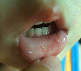 宝宝爱流口水可能不是长牙, 而是