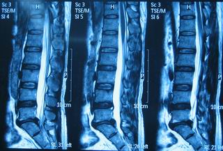 即用各种牵引装置,包括机械或电动牵引床进行间歇性牵引