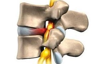 腰椎間盤突出