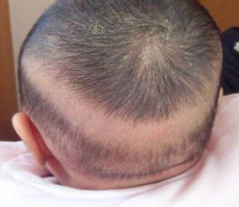 "枕秃"跟钙到底有多大关系 妈妈看完再也不用盲目补钙了
