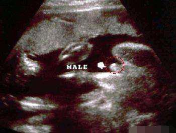 多种隔肚皮看孕妇腹中胎儿性别的办法,有几条确实准|孕妇|男孩|肚皮