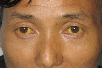 肝脏好不好可以看皮肤,养肝"四字决",呵护你的小心肝