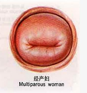 一般阴道会比没有生育过的更松弛一点,没有生育过的宫颈一般是一个小