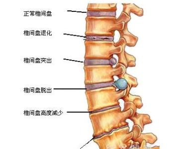 转起|突出|腰椎间盘|髓核_新浪新闻