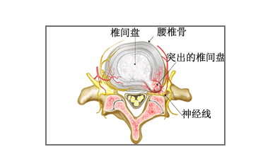你的腰椎间盘突出还在反复发作吗?腰突朋友们从此迎刃而解了