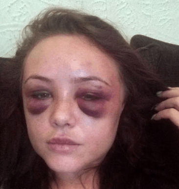 女子只因一条短信, 被丈夫打成鼻青脸肿, 短信内容只有6个字!