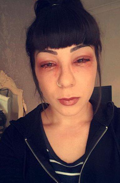 医生第一眼看到lisa还以为是被别人揍了,这眼睛很吓人呐,最终诊断为