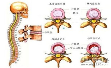 药店一味陈本不到2元的药竟然治好了我十年的腰间盘突出强