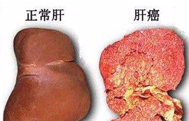 32岁台湾小生因肝癌去世,复发仅2周,回家5分钟辞世