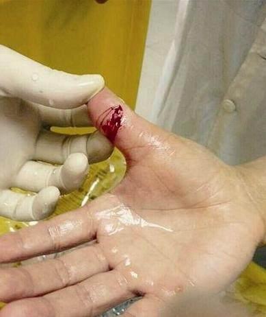 母亲被人咬破手指,没要医药费反给对方1000元医药费,对方傻了眼