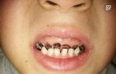两岁宝宝满嘴都是黑牙,检查结果竟是妈妈夜间喂奶的缘故