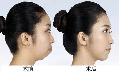 脸型不漂亮? 下巴是关键