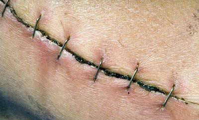 产妇剖宫产35天,伤口突然崩裂流血,医生怒骂:婆婆不是人