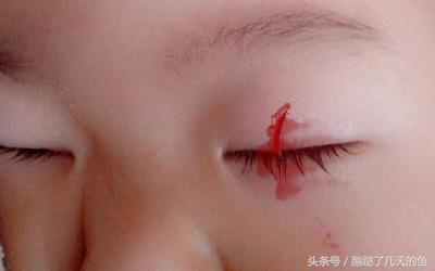 4岁孩子在家眼睛被戳伤爸爸回家第一时间做了3件事