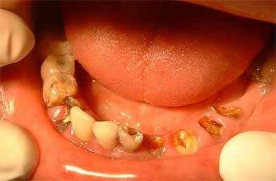 5岁男孩患牙龈癌, 原因是每天喝这种东西, 很多人都喝过