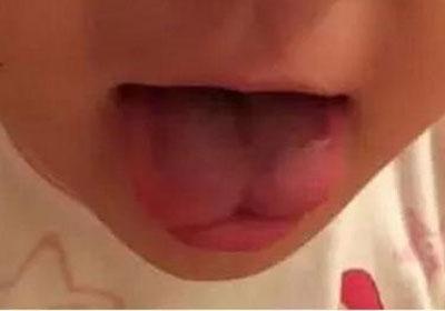 新生儿舌头短图片
