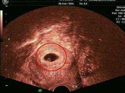 3孕囊数据等差递减