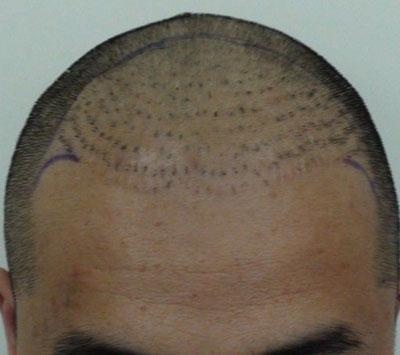 植发需谨慎…植发失败真的是惨不忍睹!这类人