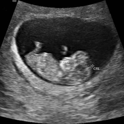 孕十周胎儿真实图片图片
