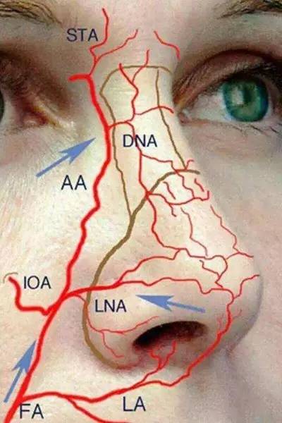 玻尿酸隆鼻一定很安全吗