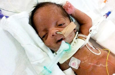 nina提前8周生下儿子louis,孩子出生时体重就很弱,无法自动呼吸,头大