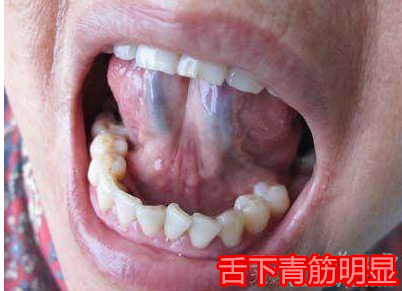 翻舌头看看,爆青筋的有危险!血管有血淤,是凶是吉就看个人了