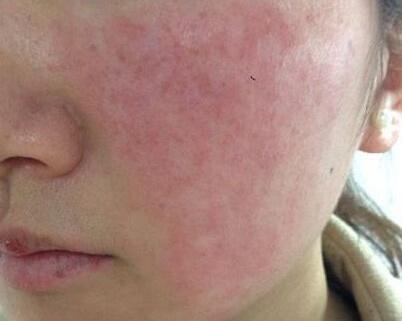 敏感性皮肤常见的一些形成原因和应对方法,别说不会改善啦