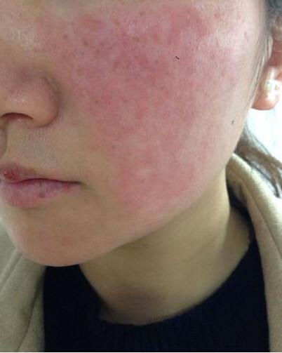 角质层薄,有红血丝,脸经常很烫,用什么护肤品不会过敏?