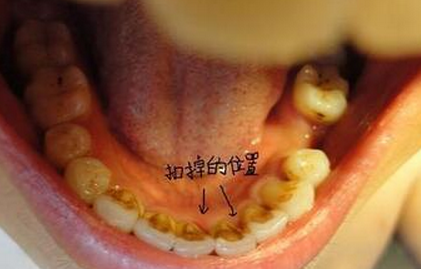 只需这几招,一周就能祛除牙黄牙结石!
