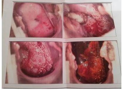 17岁少女下身大量出血,医生抢救2小时,男友不见踪影