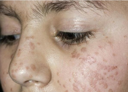 扁平疣主要是由人类乳头瘤病毒引起的,发病时多集中在脸部,手背和手臂