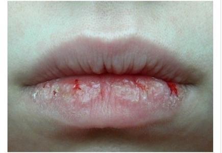 为什么一到冬天嘴就起皮, 原因真的只有干燥?|嘴唇|干燥|唇炎_新浪新