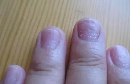 营养不良或者缺乏微量元素引起,则应在食物中相应补充;* 宝宝指甲反