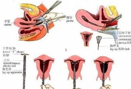 带节育环对女性的身体有哪些不良反应呢?不知道的,亏大了
