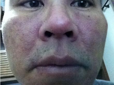 酒精肝患者: 常喝酒要留意身体3个地方变化, 可能你也中招了!