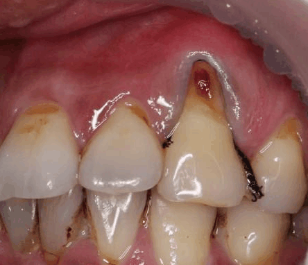 平时都在好好刷牙 怎么牙根却开始烂掉了