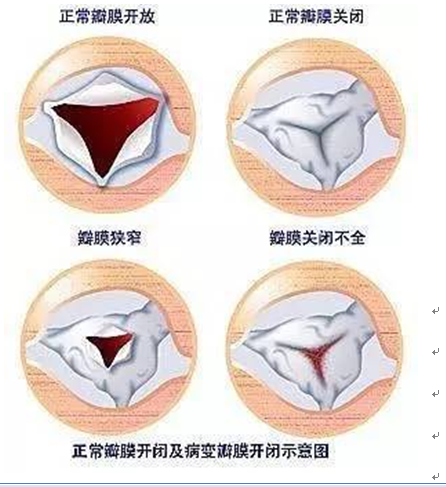 疾病|主动脉瓣关闭不全|主动脉瓣狭窄_新浪新闻